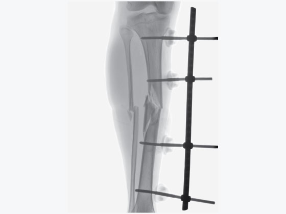 Limb Reconstruction